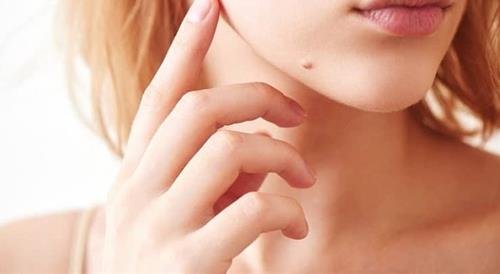Nốt ruồi dưới cằm