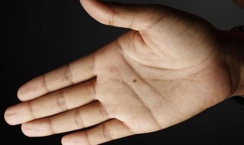 nốt ruồi ở lòng bàn tay not ruoi o long ban tay