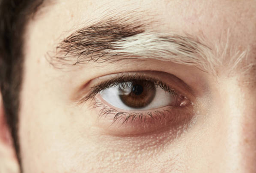 Lông màu trắng mọc ở chân mày Long mau trang moc o chan may