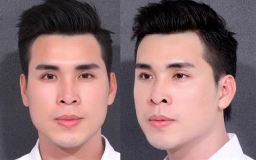 Lỗ mũi to và hếch Lo mui to va hech