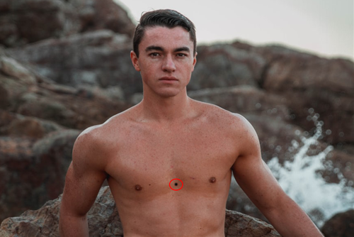 Not ruoi o giua nguc tinh tinh keo kiet