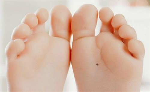 nốt ruồi ở lòng bàn chân not ruoi o long ban chan