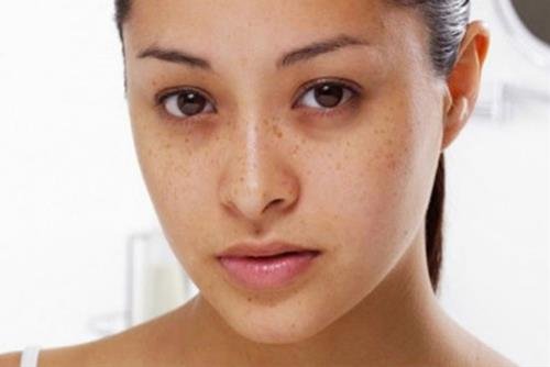 Quầng mắt thâm bẩm sinh Quang mat tham bam sinh