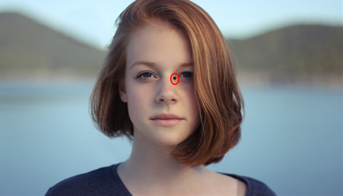 Vi tri not ruoi xau tren co the phu nu