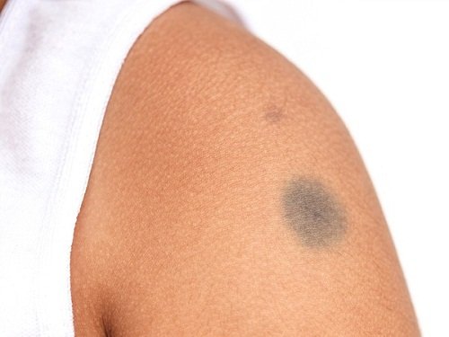 Xem tuong vet bot de don dau tuong lai tuoi sang cho tre hinh anh 2