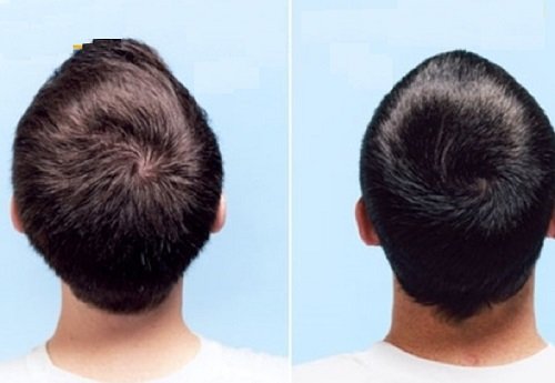 Xem tướng xoáy tóc trên đầu để hiểu thêm về mình hình ảnh gốc Xem tuong xoay toc tren dau de hieu them ve minh hinh anh goc